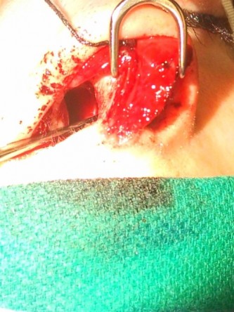Repair of Nasal Septal Perforation* — Before