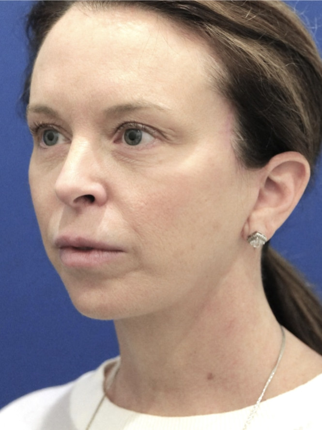 Jowling and Skin Laxity — After