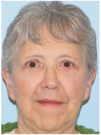 Endoscopic Browlift1* — After