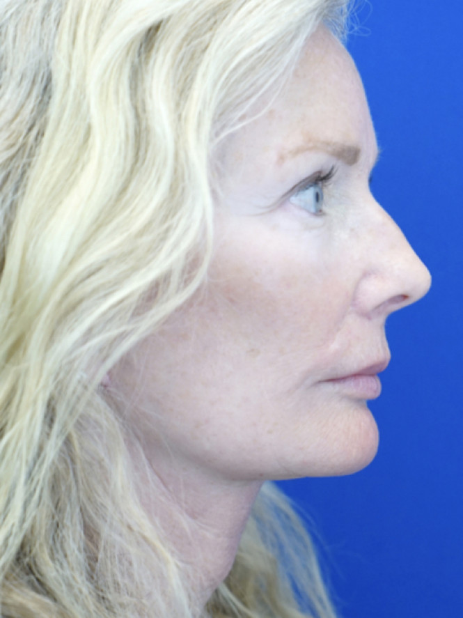 Scintillating Natural Result — After