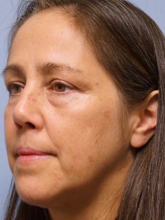 Nasal Septal Perforation2* — After
