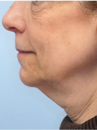 Full Face and Necklift, Upper and Lower Eyelid, Browlift* — Before