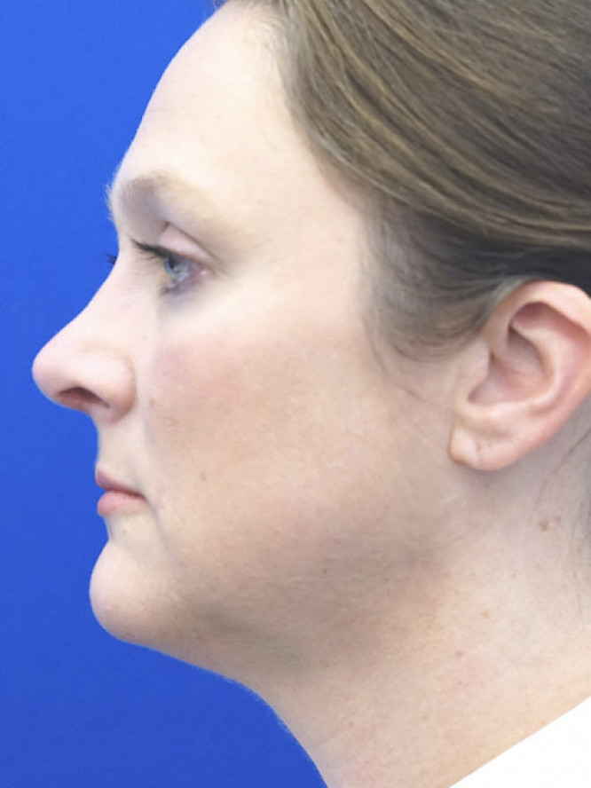 Nasal Profile Femininity — After