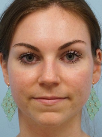 Fractional CO2 Laser Skin Resurfacing1* — After