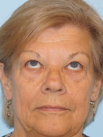 Upper Eyelid Droop and Skin Excess* — Before