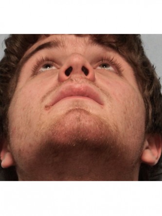 Nasal Fracture – Nostril Asymmetry* — After