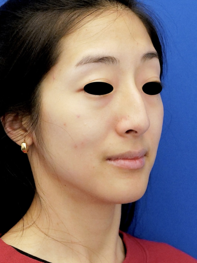 Preservation Ethnic Rhinoplasty — Before