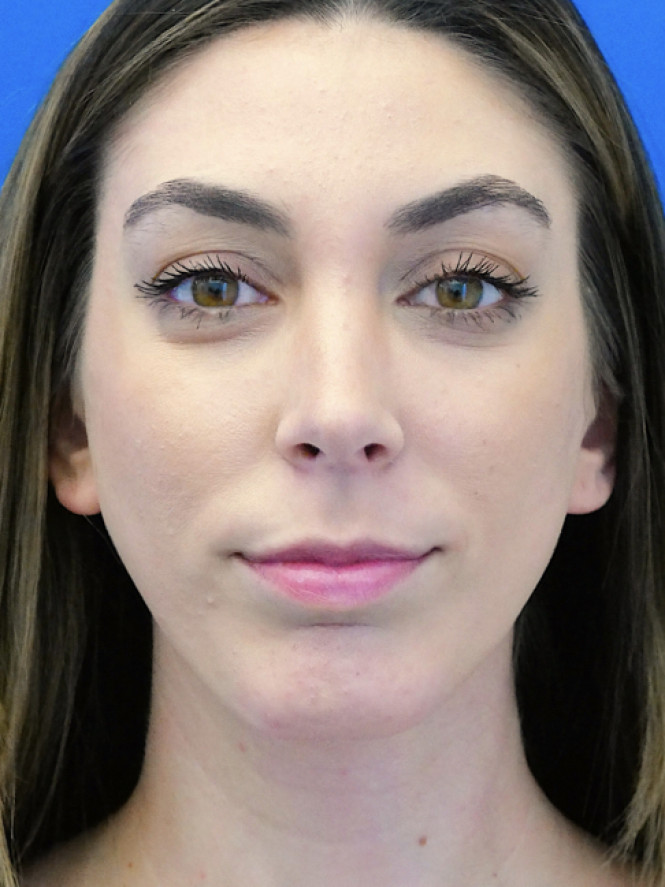 Facial Profile Balance — After