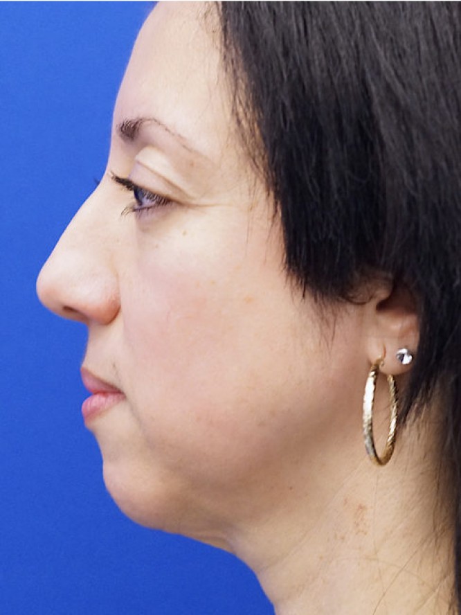 Natural Result — Before