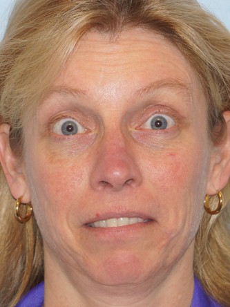 Upper Eyelid Droop1 (Ptosis)* — After