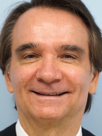 Fractional CO2 Acne Scar Resurfacing* — After