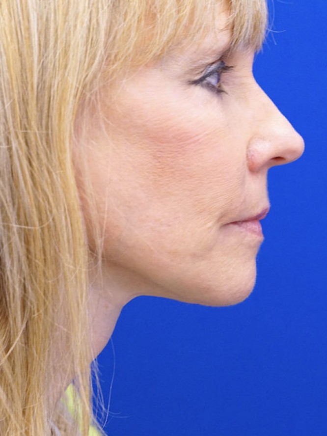 Neck Rejuvenation — After