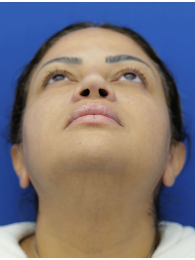 Narrow Nostril Base — After