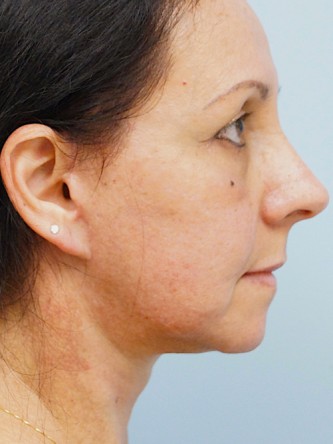 Aging Eyelid Rejuvenation, Facelift, Necklift 2* — After