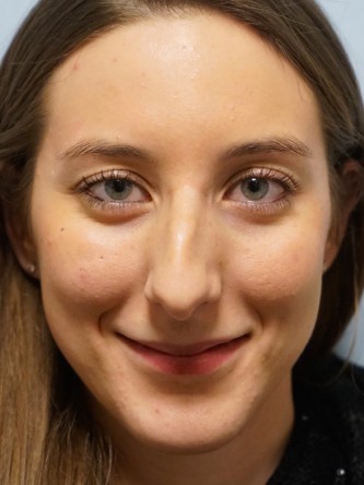 Nasal Hump Endonasal Rhinoplasty* — Before