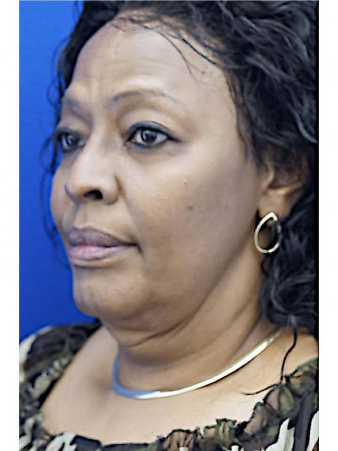 Necklift Platysma Suspension and Liposuction — Before