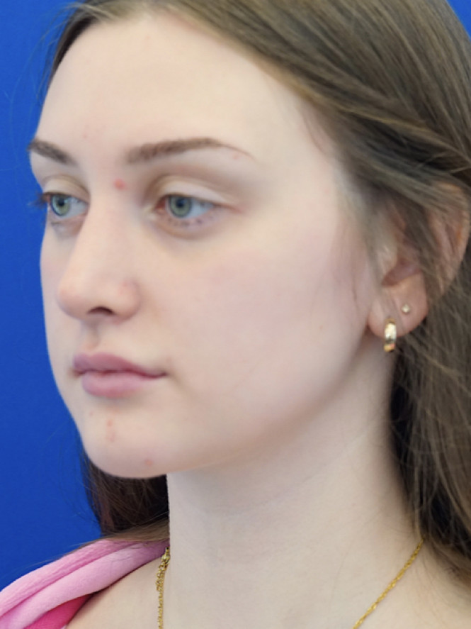Natural Profile — After