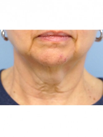 Neck Lift* — Before