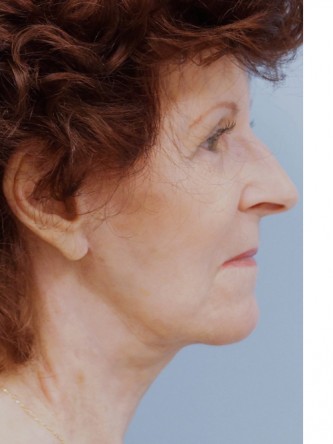 Facelift, Necklift, Platysmaplasty, ERB:YAG Laser Resurfacing* — After