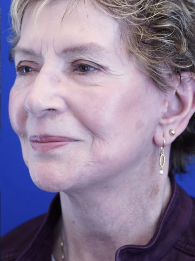 Deep Plane Facial Rejuvenation — After