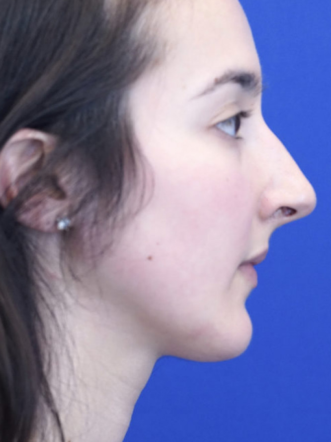 Endonasal Finesse Rhinoplasty — Before