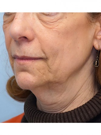 Full Face and Necklift, Upper and Lower Eyelid, Browlift* — Before