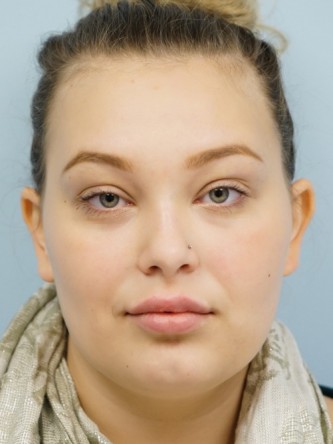 Restylane Silk Achieves Voluptuous Lips* — After