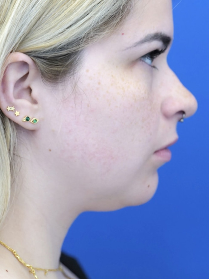 Underchin Fullness — Before