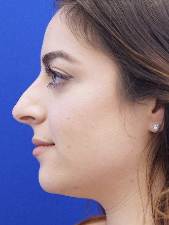 Finesse Nasal Aesthetics* — Before