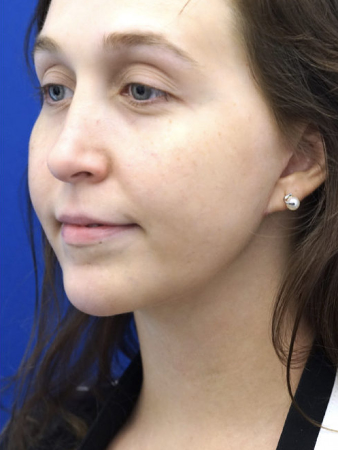 Necklift Subplatysmal Lipectomy — After
