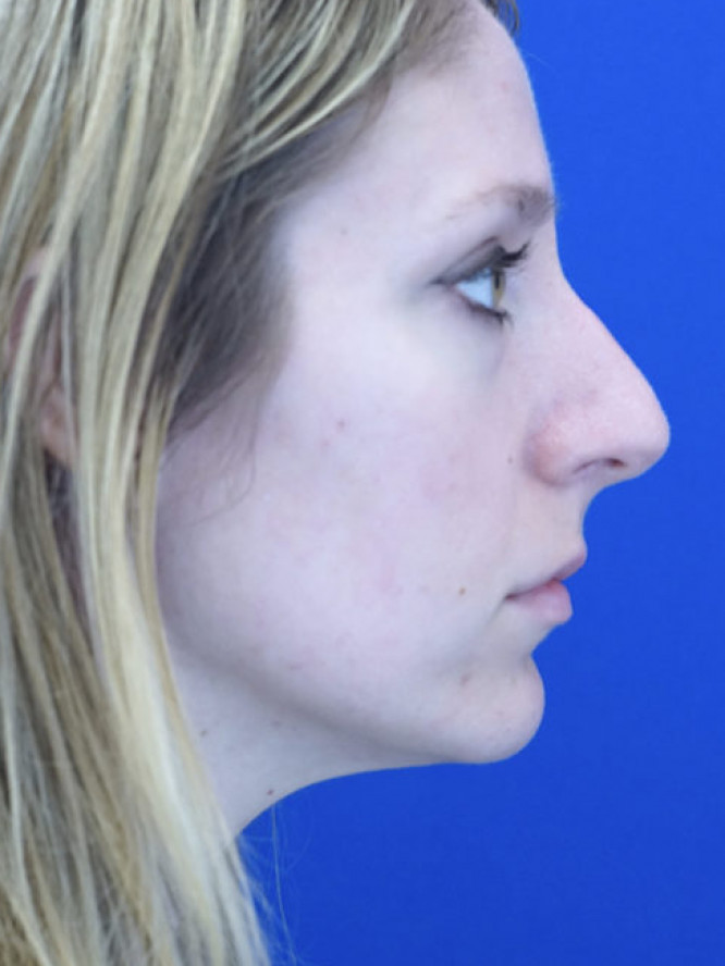 Nasal Profile Finesse — Before