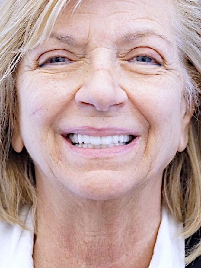 Jowls and Loose Neck Skin — Before