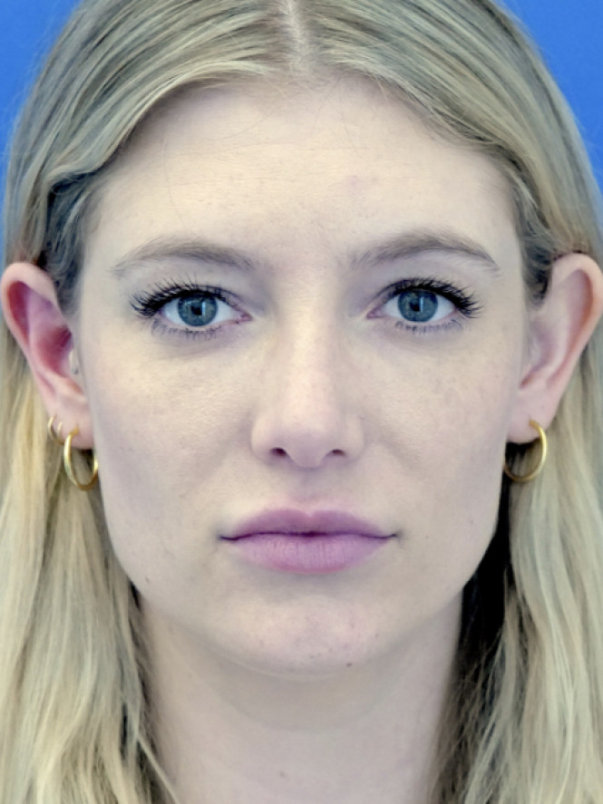 Aesthetic Nasal Contour — After