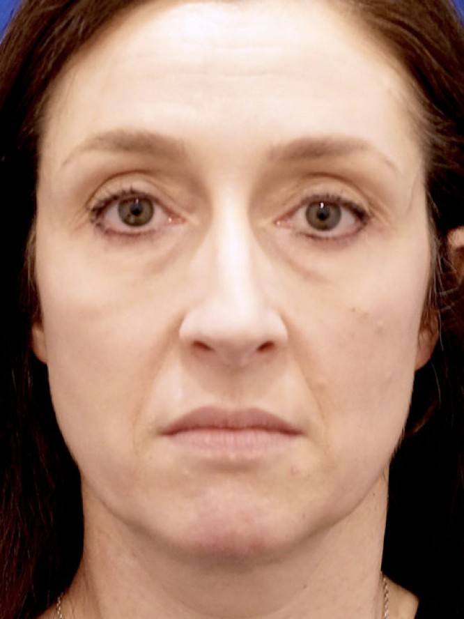 Nasal Aesthetic Nuances — Before