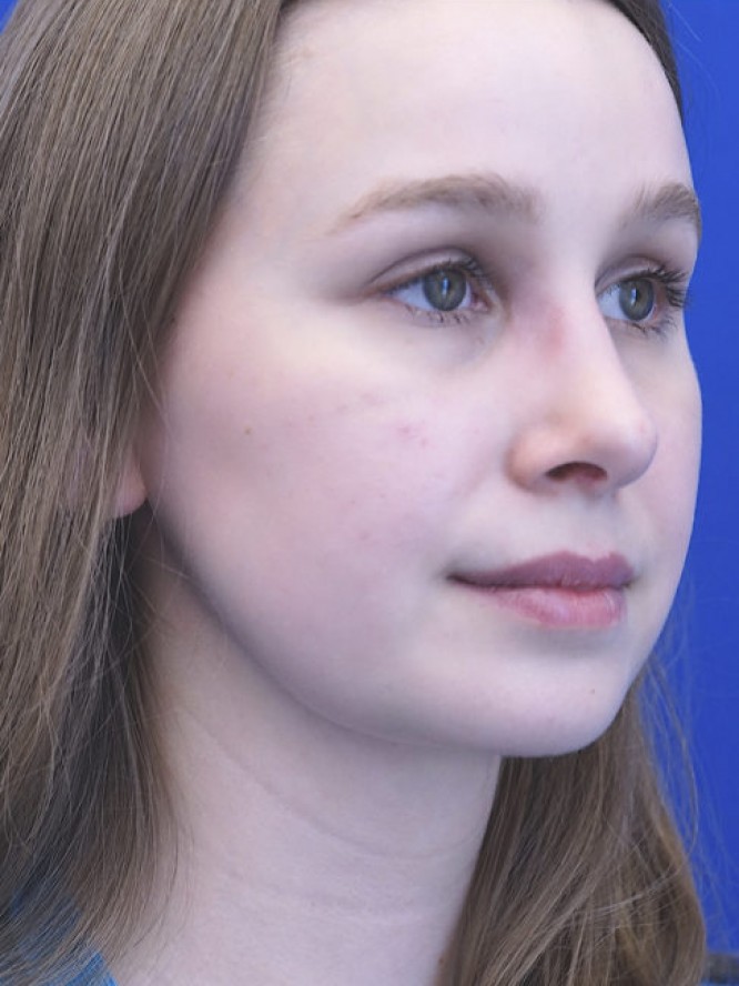 Facial Profile Plasty — After