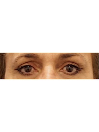 Endoscopic Browlift and Eyelid Skin Excess* — After