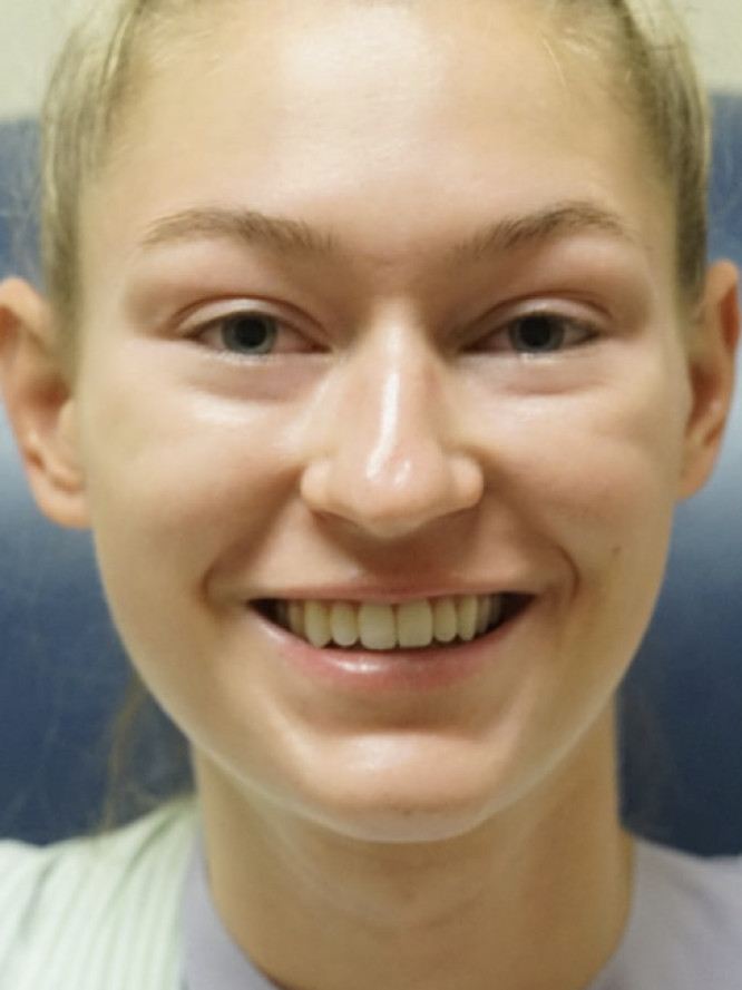 Nasal Profile Plasty — Before