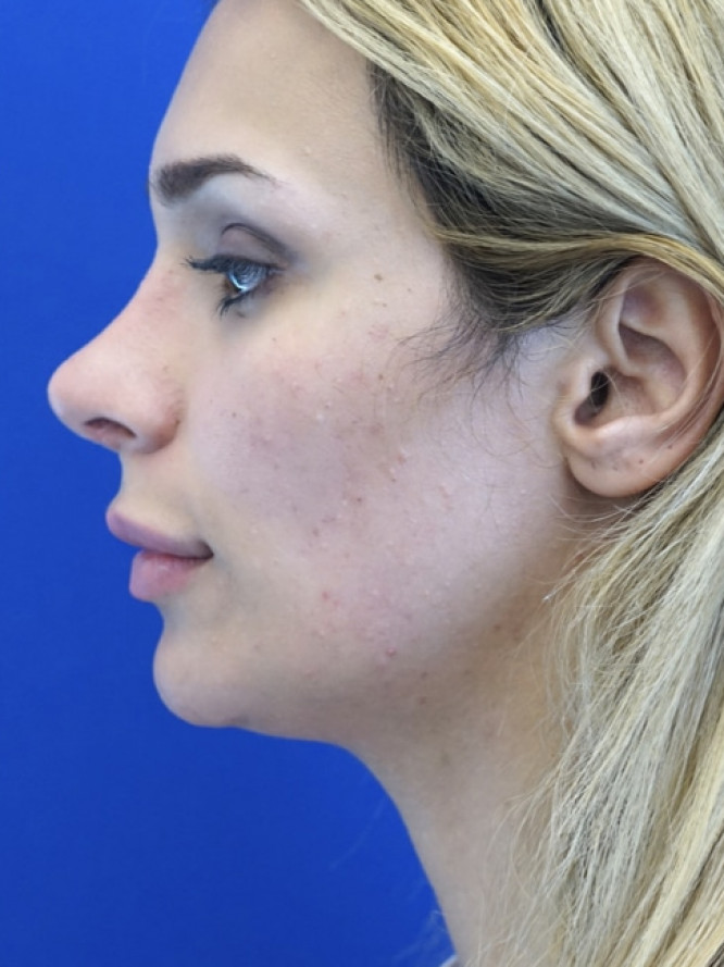 Nasal Deviation and Dainty Tip — After