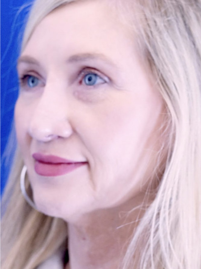 Thick Skin Droopy Nose — After
