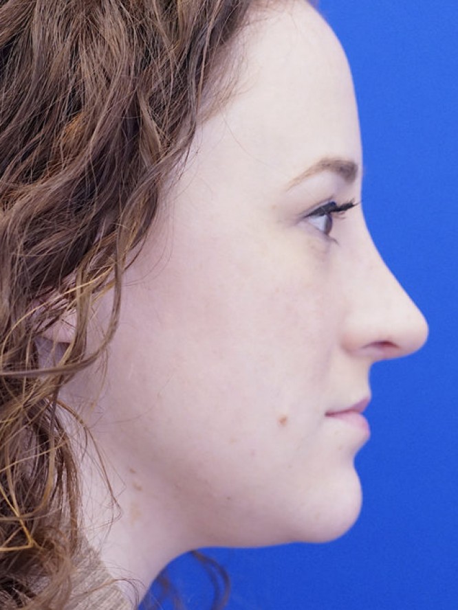 Finesse Nasal Contour — After
