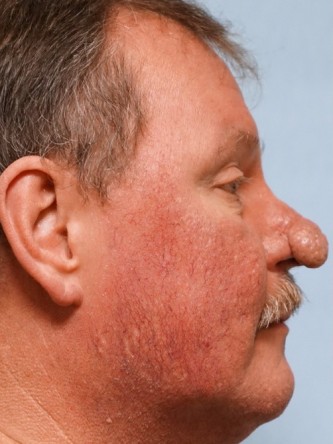 Rhinophyma* — Before