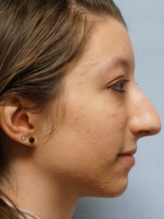 Prominent Nose Closed Rhinoplasty* — Before