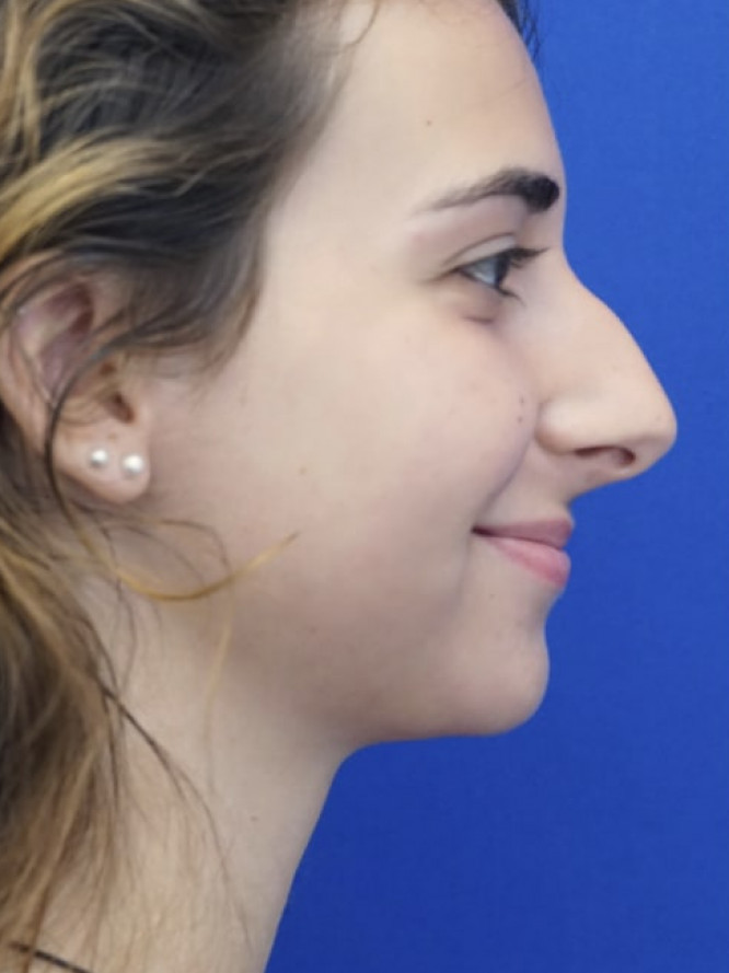 Classic Tension Nose — Before