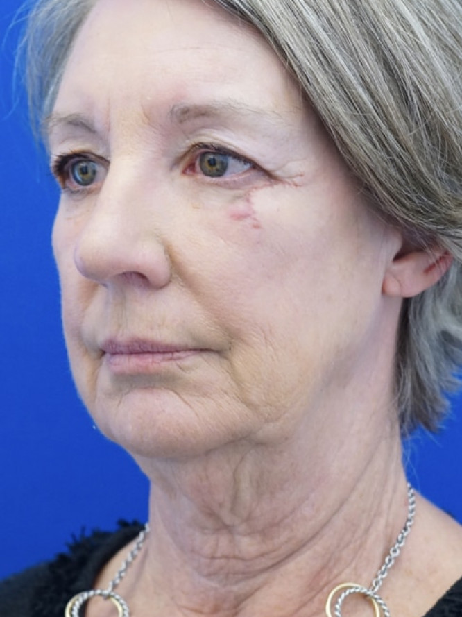 Deep Plane Face and Neck Lift — Before