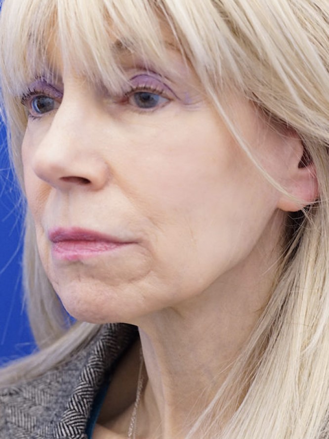 Crisp Jaw and Neck Lines — Before