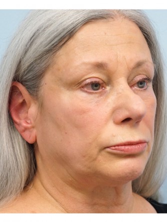 Over Projected Thick Skin Nose* — Before