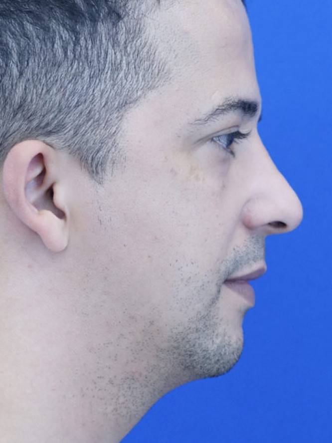 Endonasal Hump Removal — After