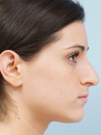 Mild Dorsal Hump & Droopy Tip1* — Before