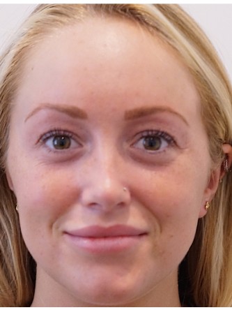 Restylane Silk to Upper & Lower Lips* — After