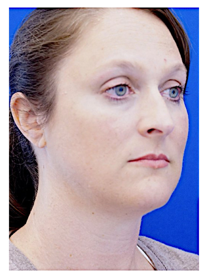 Nasal Profile Femininity — Before